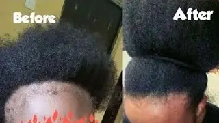 Your Hair Will Never Stop Growing With These 2 Ingredients | Grow Long And Thicken Hair Faster