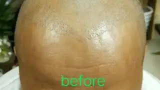 SMP纹发修复植发失败。SMP repair hair transplant failed.