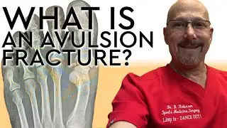 What is an Avulsion Fracture? AND How to Splint One