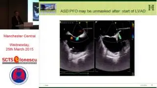 Transoesophageal echocardiography in Mechanical Assist