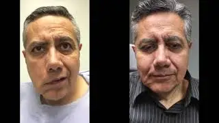 nerve to masseter transfer