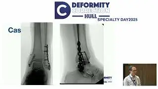 Strategies for malunion around the ankle
