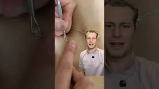 Nice cyst pop! #fyp #pimple #satisfying #pop #skin