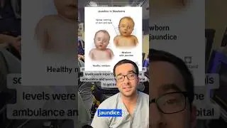Newborn Jaundice WHAT Parents Really Need To KNOW