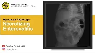 Necrotizing Enterocolitis