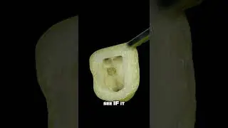 Biodentin  Cavity Repair Demo 🕳️🦷