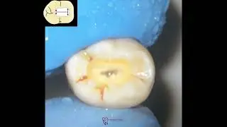 Access cavity of lower molar step by step