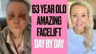 Day By Day 63 Year Old Facelift Transformation - 2 Month Journey - An Honest Account
