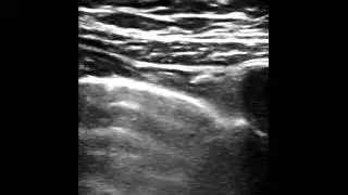 Normal Lung sliding