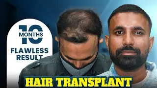 NW-5 Hair Transplant Result | 4000 Grafts FUE | Hairfree & Hairgrow Ahmedabad