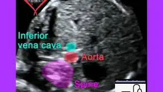 Asplenia