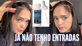 6 MESES USANDO MINOXIDIL NO CABELO | MINOXIDIL FUNCIONA? | COMO APLICAR MINOXIDIL