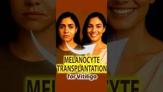 Vitiligo Melanocyte Transplant ✨ Effective Treatment in Delhi | Dr. Sandeep Bhasin