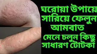 আমবাতের ঘরোয়া চিকিৎসা/যে ঘরোয়া টোটকা গুলি ব্যবহার করে আমবাতের হাত থেকে মুক্তি পাবেন॥