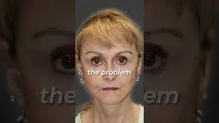 My Facelift Recovery Story #recovery #facelifts