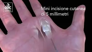 ECOCHIRURGIA DELLE DITA A SCATTO