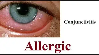 Allergic Conjunctivitis