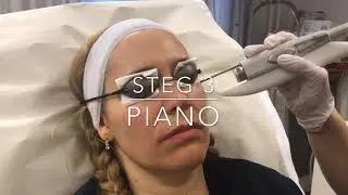 4D Laserbehandling - Ansiktslyft med laser- Veritaskliniken