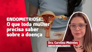 Endometriose: o que toda mulher precisa saber
