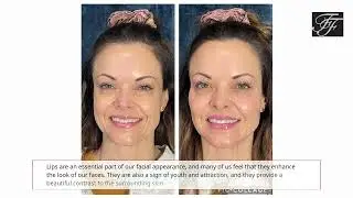 Dermal Fillers - Flawless Faces Med Spa Chandler