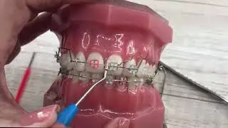 4   LIGADURA METÁLICA