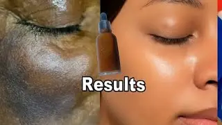 Effective treatment for wrinkles eraser all fine lines and dark circles