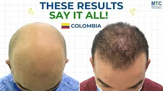 Best Hair Transplant Clinic in Colombia? MTC Reveals the Experts Behind These Results!