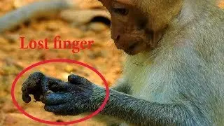 Pitiful poor Baby Janet lost one finger by trap, Janet Mother careless stay alone