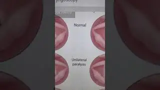 Vocal Fold Paralysis #Shorts