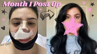 ✨🎀 My Ethnic Rhinoplasty Glow-up One Month Post Op Results 🎀✨