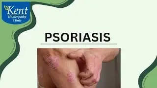 Psoriasis -  best Homeopathy treatment Dr Kukreja Kalani  online consult 8291492566