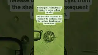 Hatching of a freshly thawed blastocyst before embryo transfer.