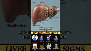 What REALLY Happens If You Ignore Liver Cancer Warning Signs