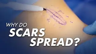 Scar Spreading - Why does it Happen?