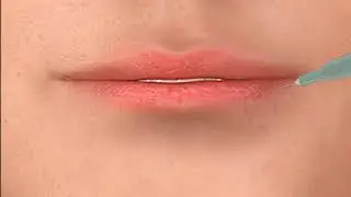 Dermal Fillers