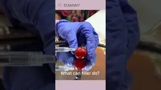 The Power of Filler: Discover What Filler Can Do for You! #dermalfiller