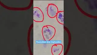 Plasmodium vivax trophozoites and schizont stages #microscopy #malaria #lens #microscope #neetpg