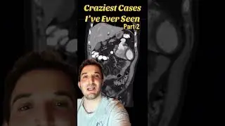 Crazy chest x-ray shows missing heart