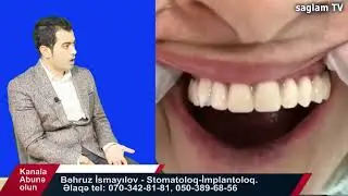PASİENTLƏR AĞIZLARINDA ÇIXAN PROTEZ YOX SABİT BİR PROTEZ İSTƏYİR.  DR. BƏHRUZ İSMAYILOV İMPLANTOLOQ