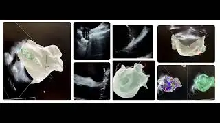 New ice catheter view flex abott