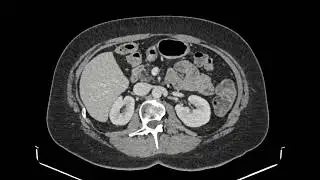 Dorsal ventral differentiation of the pancreas