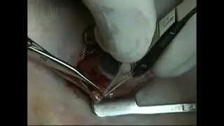 Biopsy of subconjunctival lymphoma
