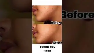 Laser Technology #skincare WhatsApp: 8658130496 #NoPain #NoBleeding #lowcost #beauty #timesavings