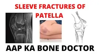 SLEEVE FRACTURES OF PATELLA IN CHILDREN - EPISODE 37