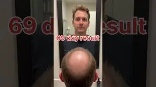 69 Din Mein Badal Gaya Sab | DHT Blocker + Minoxidil Magic 💥