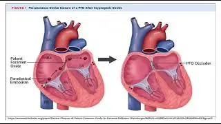 Paradoxical embolism pathology mbbs