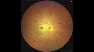 Arteritis de C&eacute;lulas Gigantes | Perdida visual | EMERGENCIA