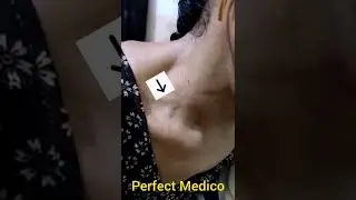 Corrigan's Sign|| Dancing Carotid pulse (Sever Aortic Regurgitation Sign)
