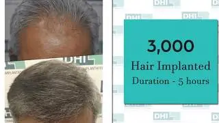 Hair Transplant Result In India Using DHI (Direct Hair Implantation) Technique