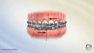 Midline Correction Elastic
